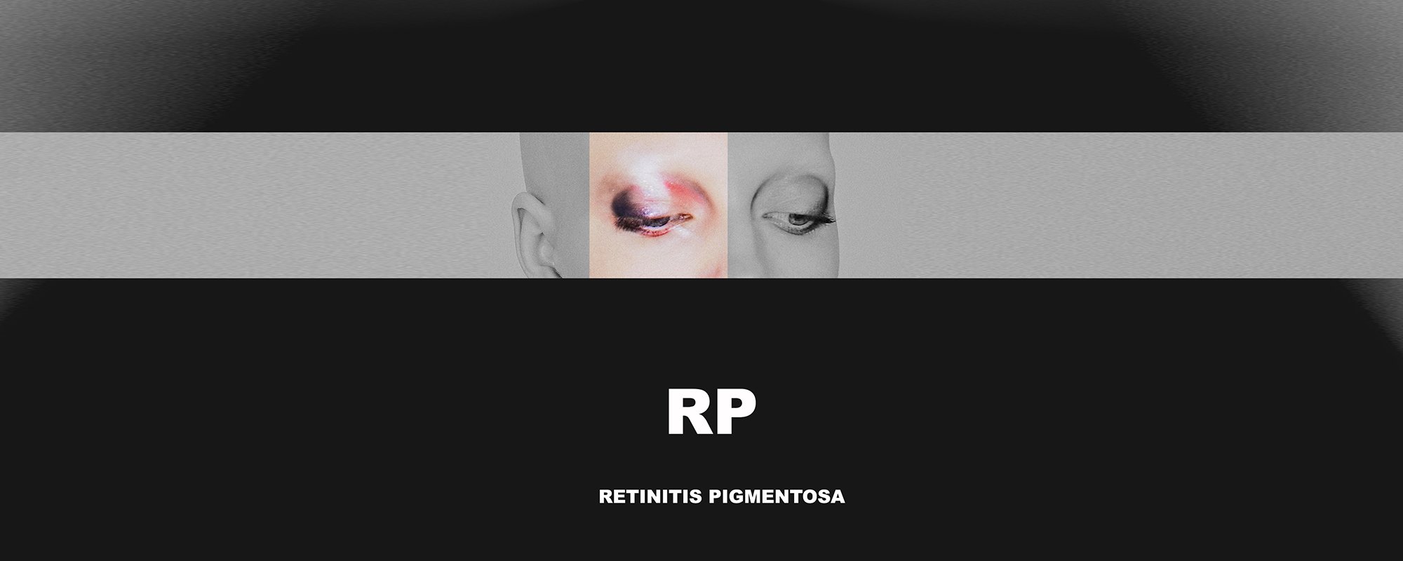 RP Retinitis Pigmentosa
